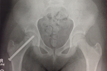 right hip photo